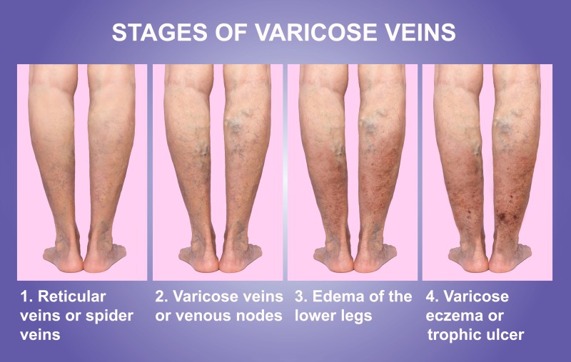 The Benefits of Getting Expert Spider Vein Removal in Schaumburg IL