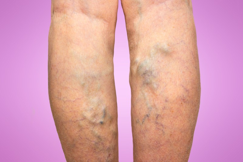 Enjoy the Benefits of Spider Vein Removal in Schaumburg, IL