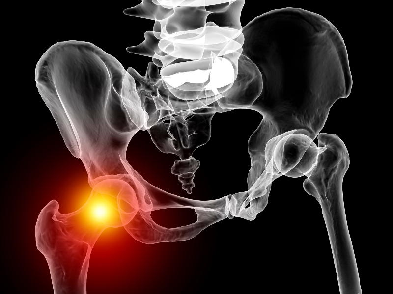 Getting Therapeutic Care after a Hip Replacement in Burnsville, MN